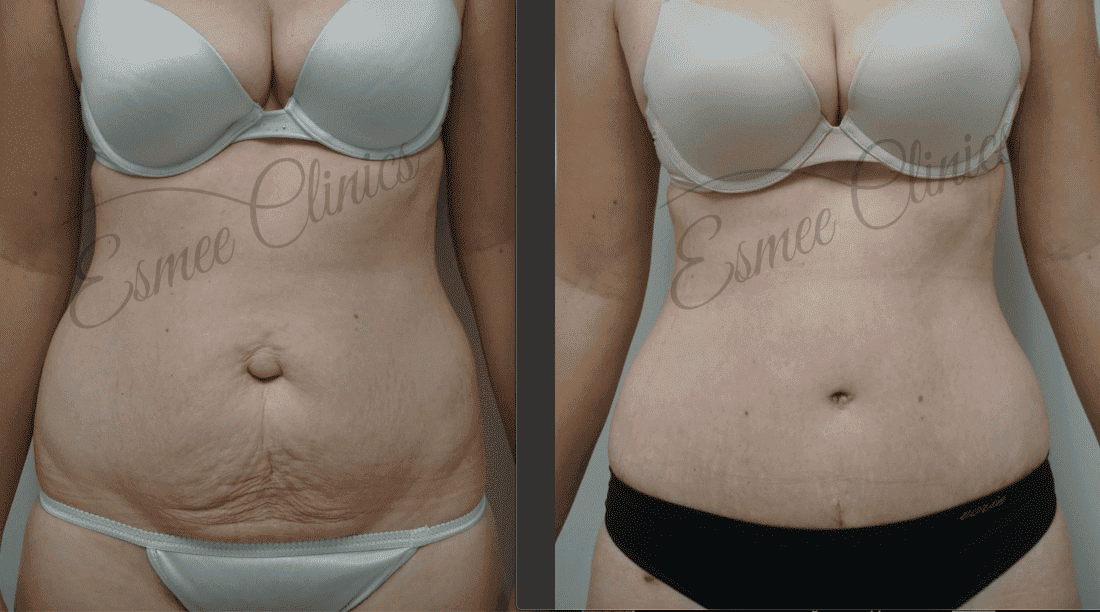 Before and After img